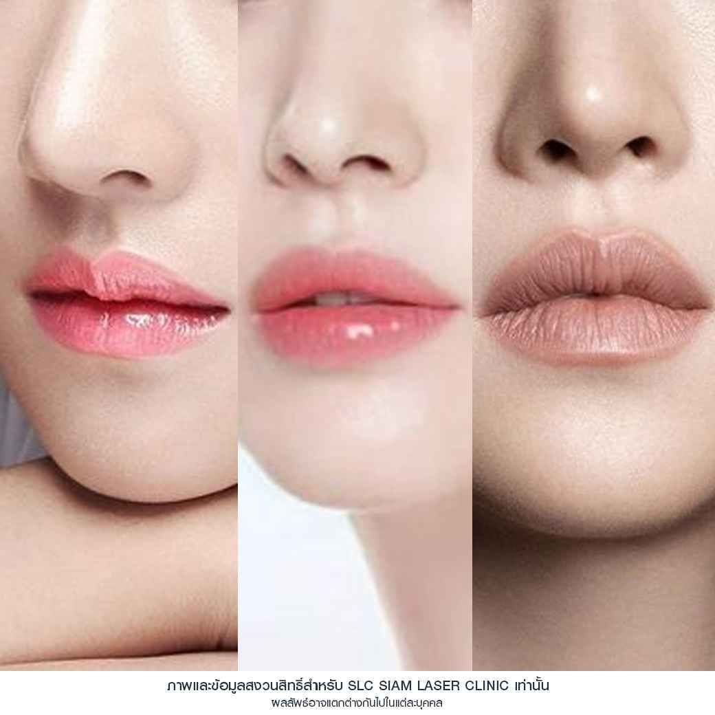 ปากฟู,3D Lips Plump Surgery , ปั้นปากสวย