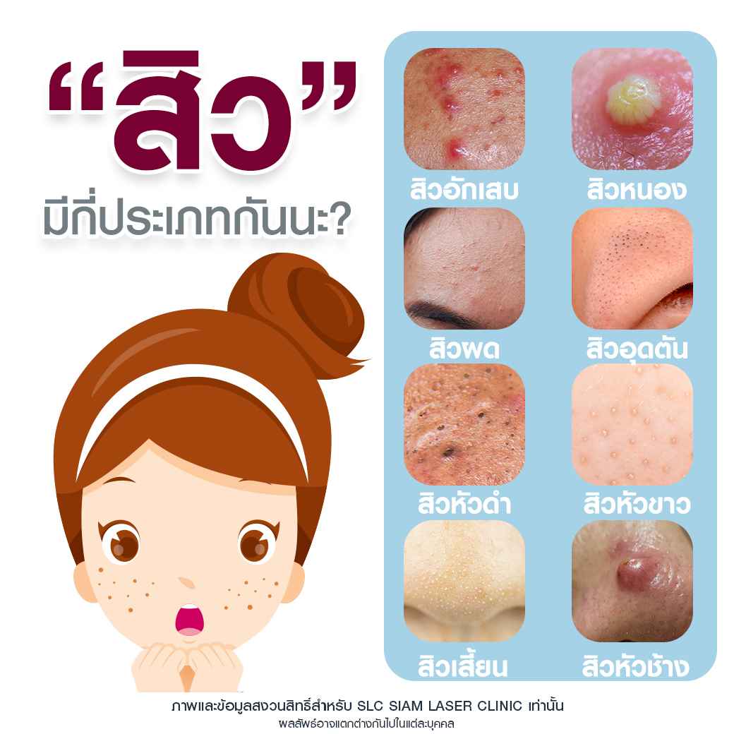 Acne Control_รักษาสิว ผิวใส