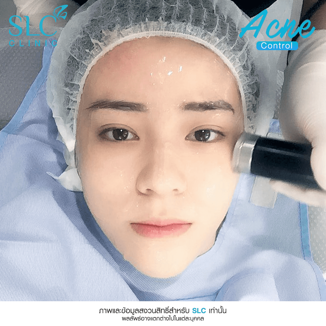 Acne Control_รักษาสิว ผิวใส