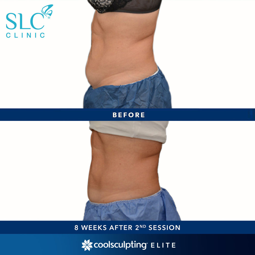 รีวิว Coolsculpting ELITE