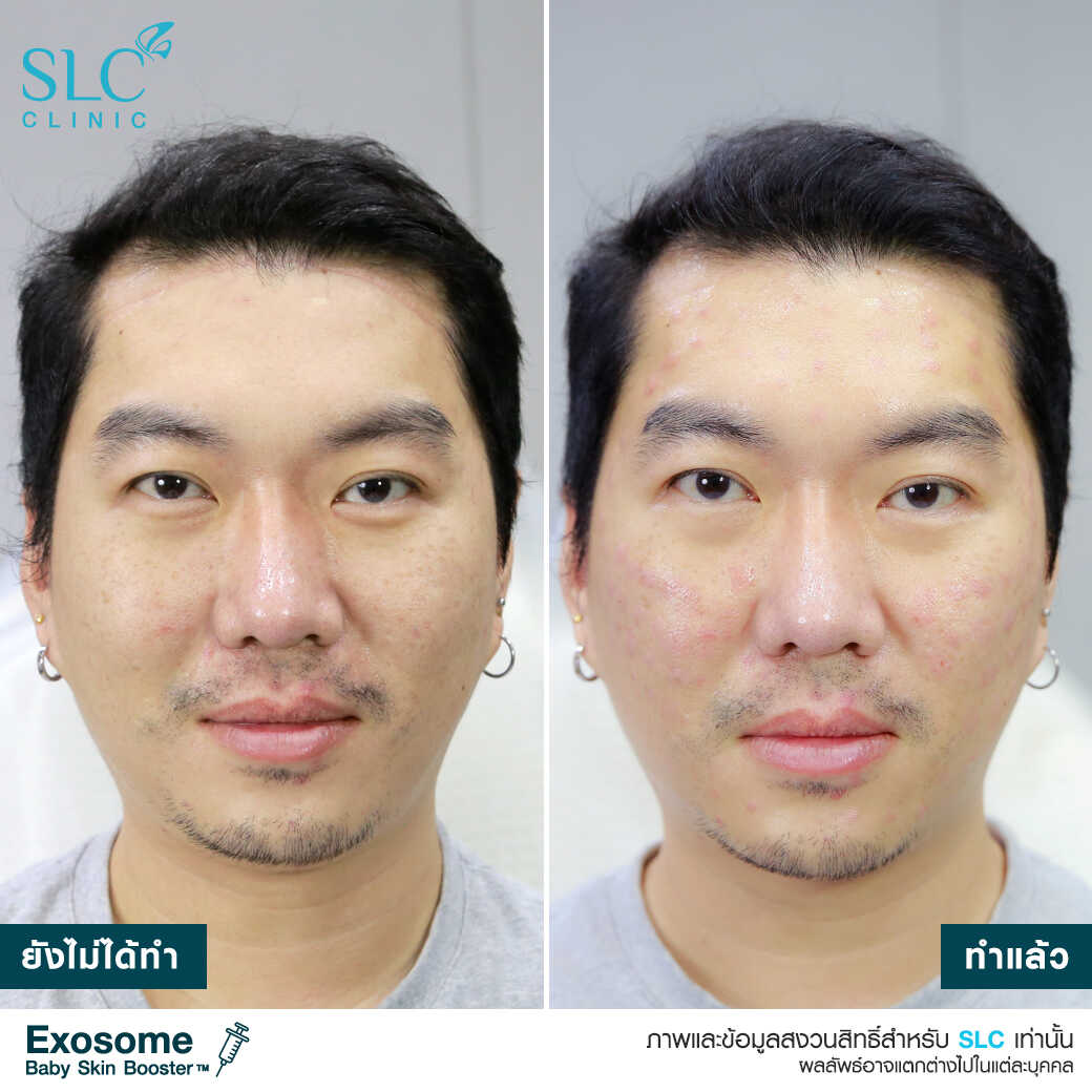 หน้ามีริ้วรอยแก้ยังไง หน้าแห้งทำไงดี ครีมลดริ้วรอย ครีมแก้หน้าแห้ง