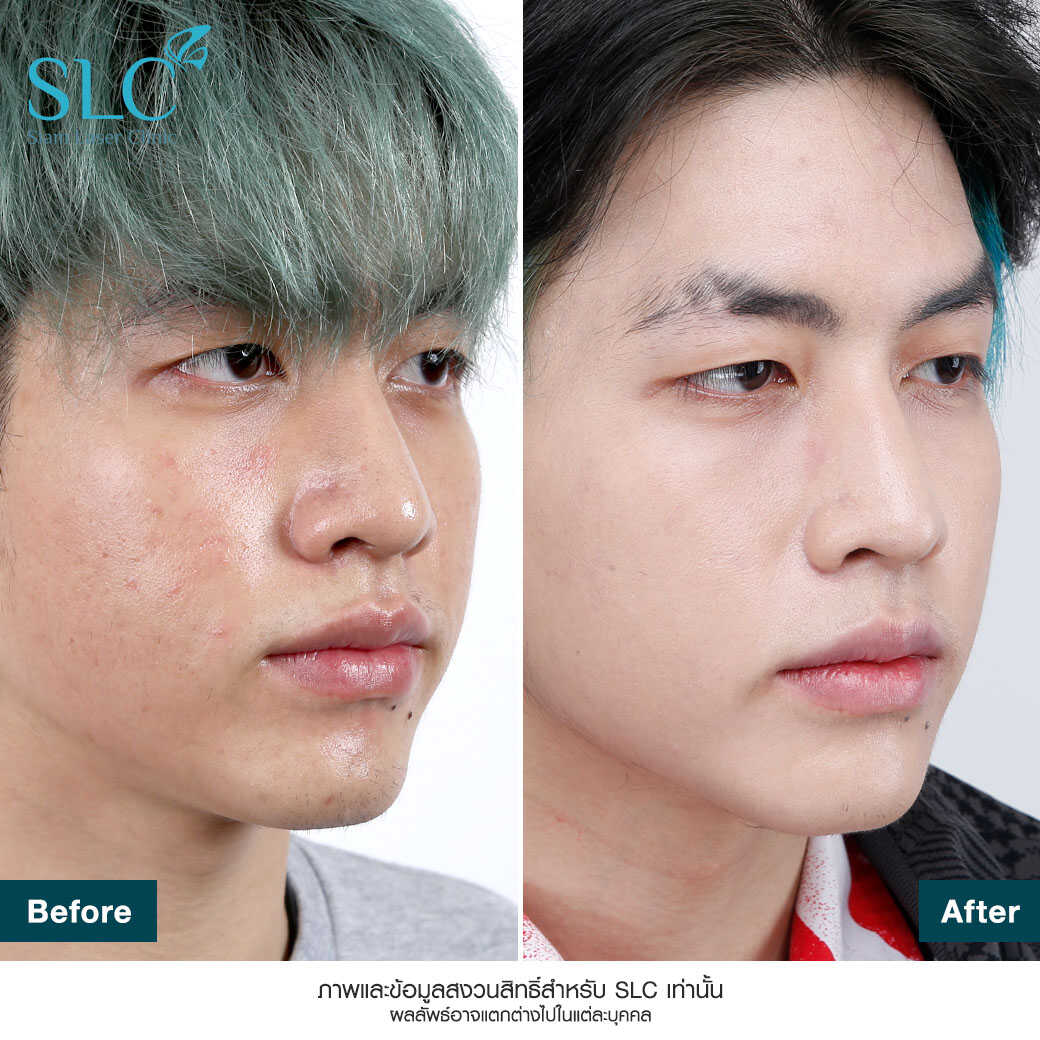 Fraxel Laser_รักษาสิว_หลุมสิว รอยแตกลาย