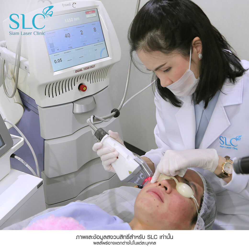 Fraxel Laser_รักษาสิว_หลุมสิว รอยแตกลาย