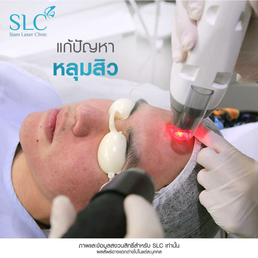 Fraxel Laser_รักษาสิว_หลุมสิว รอยแตกลาย