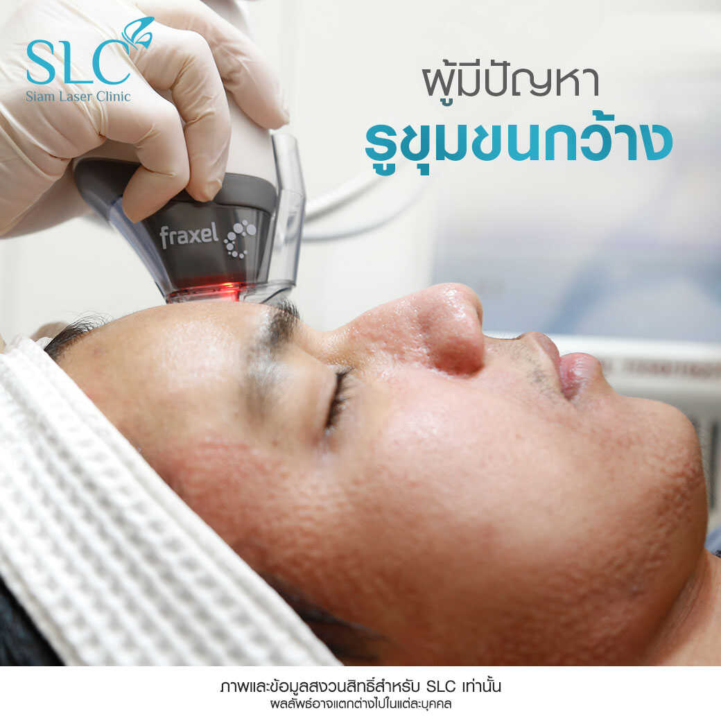 Fraxel Laser_รักษาสิว_หลุมสิว รอยแตกลาย