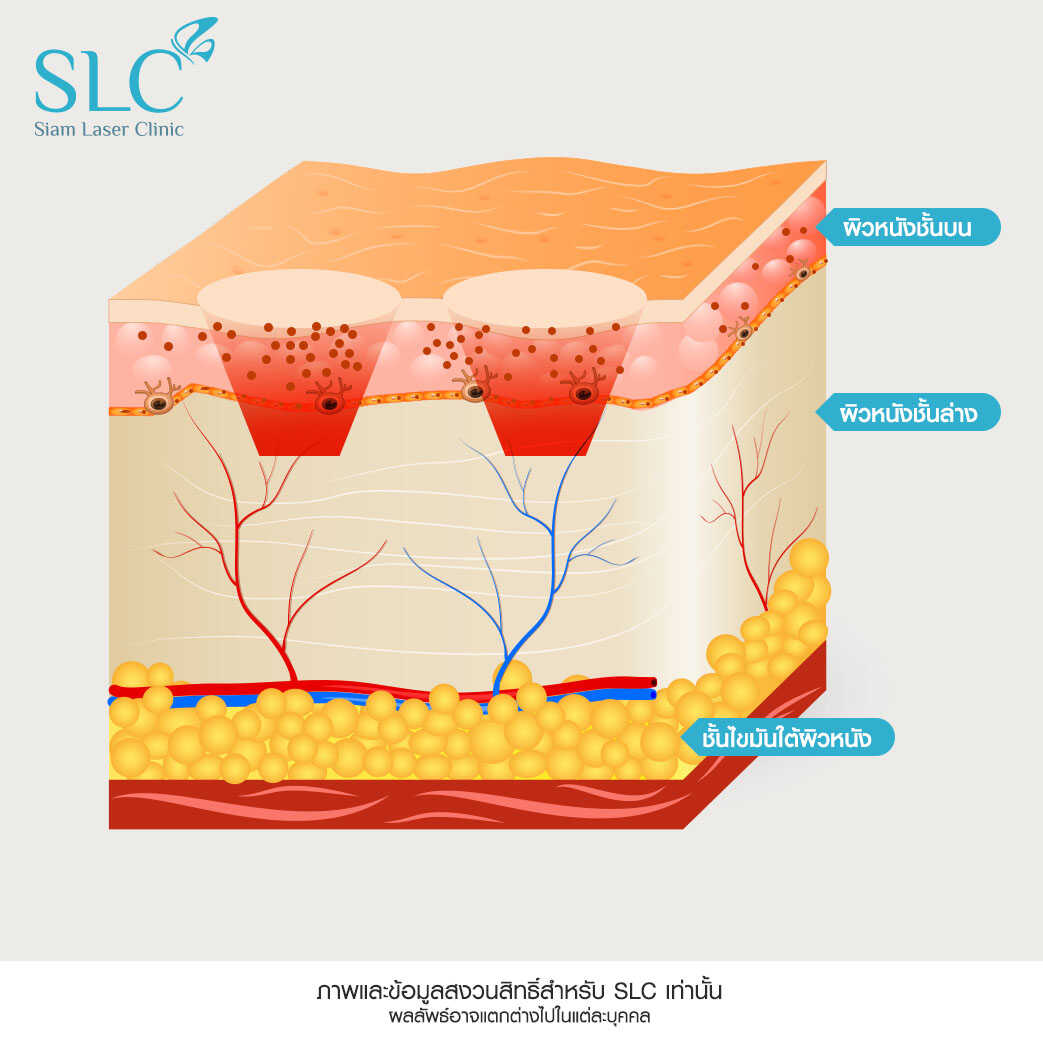 Fraxel Laser_รักษาสิว_หลุมสิว รอยแตกลาย