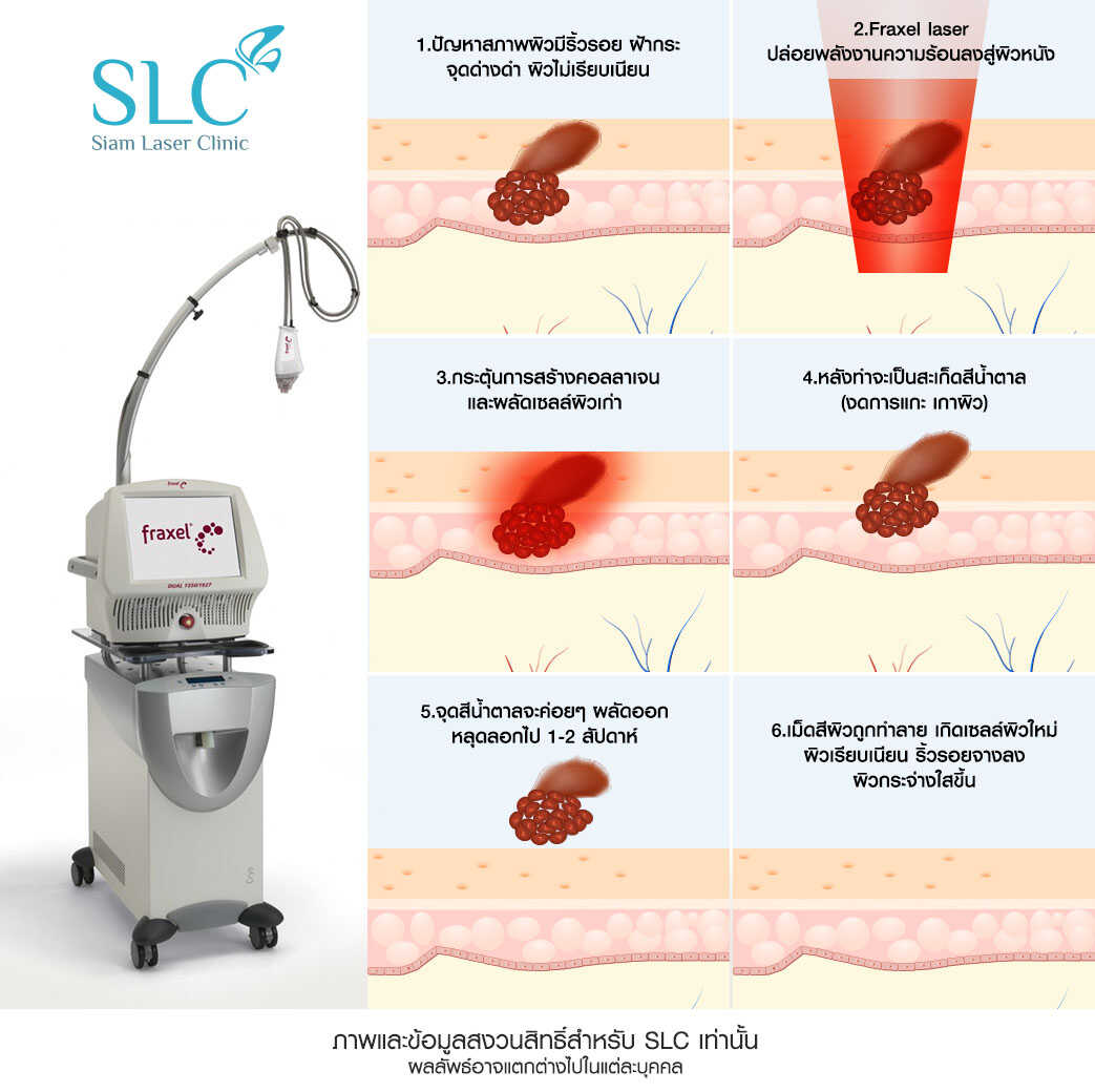 Fraxel Laser_รักษาสิว_หลุมสิว รอยแตกลาย