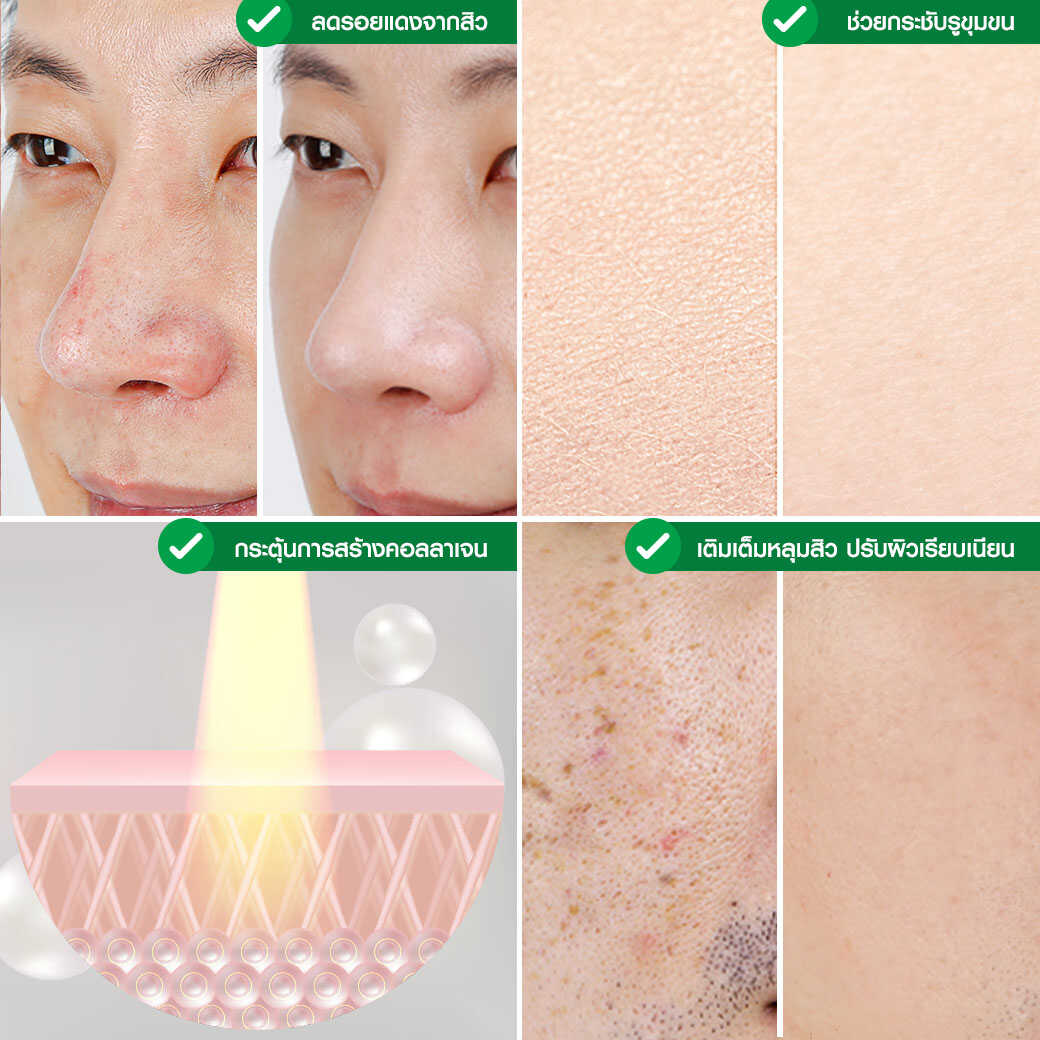 Fraxel Laser_รักษาสิว_หลุมสิว รอยแตกลาย