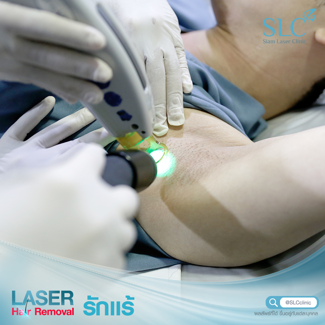 เลเซอร์กำจัดขน_Laser Hair Removal