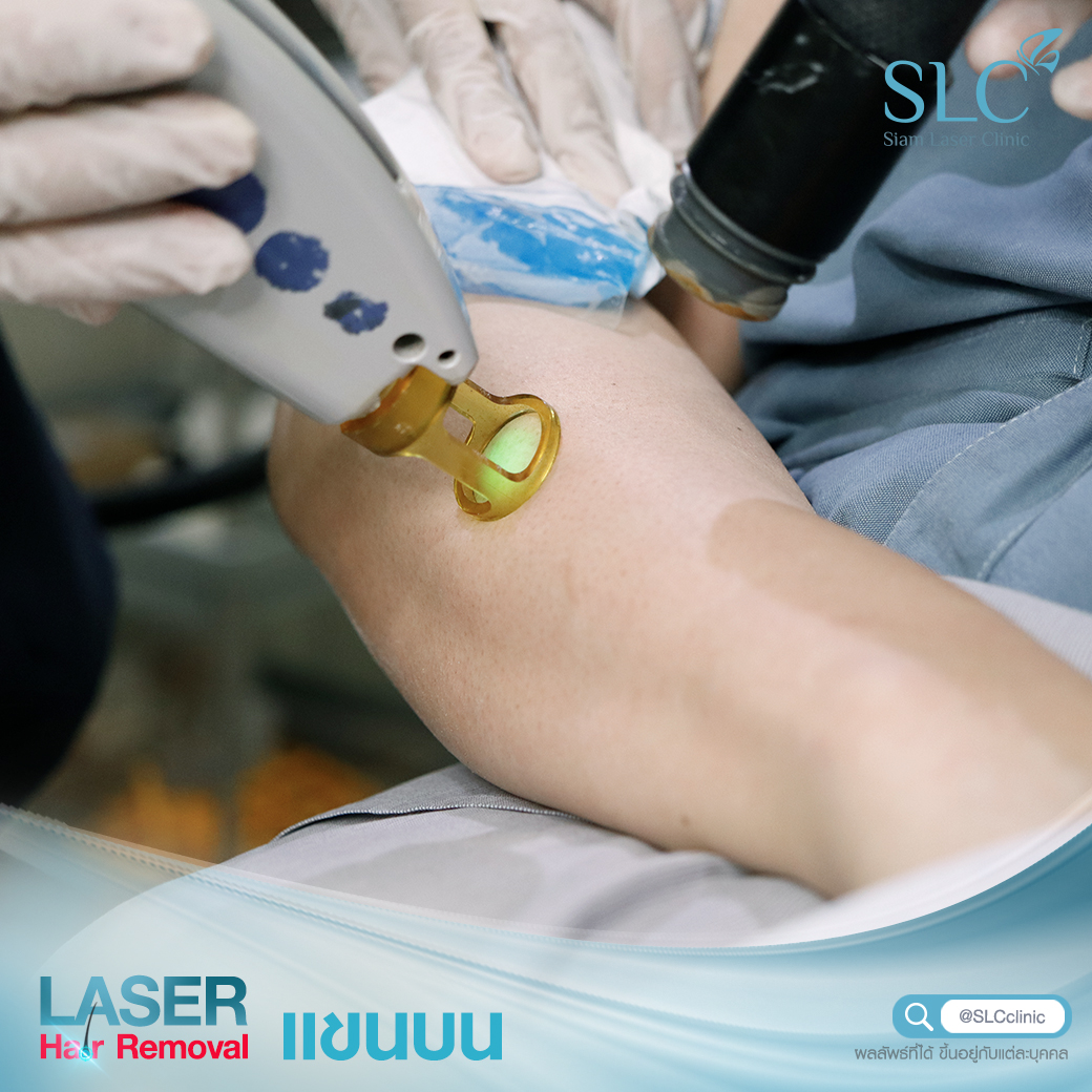 เลเซอร์กำจัดขน_Laser Hair Removal