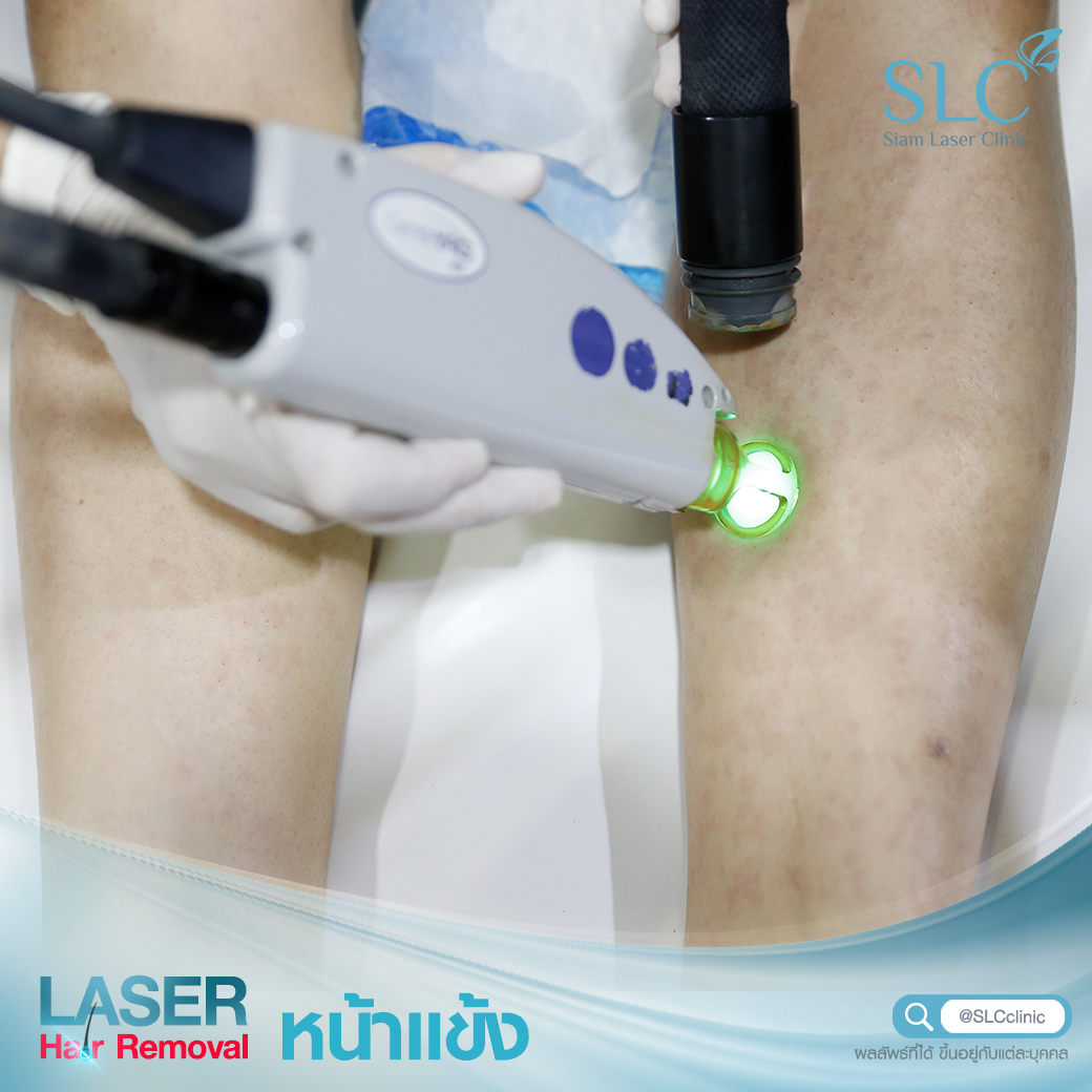 เลเซอร์กำจัดขน_Laser Hair Removal