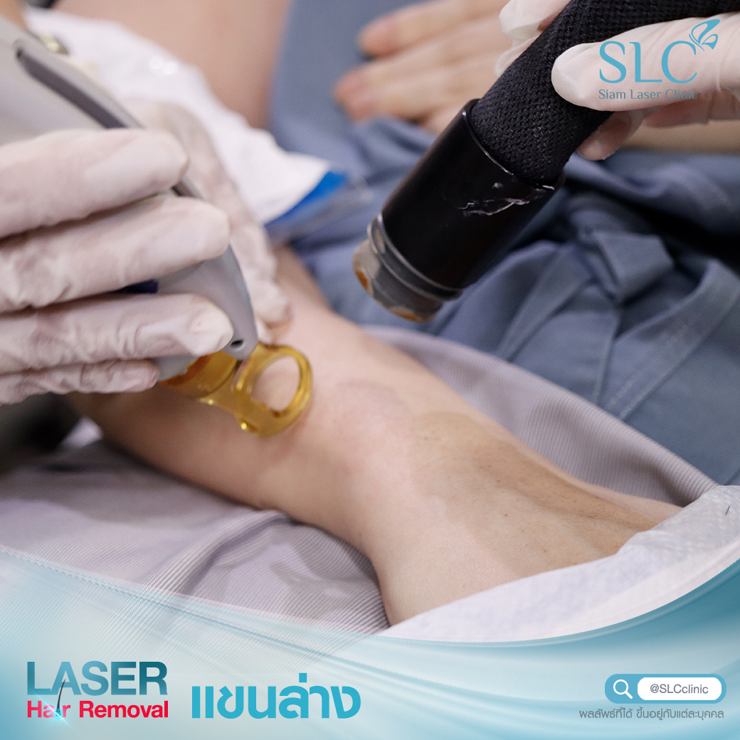 เลเซอร์กำจัดขน_Laser Hair Removal