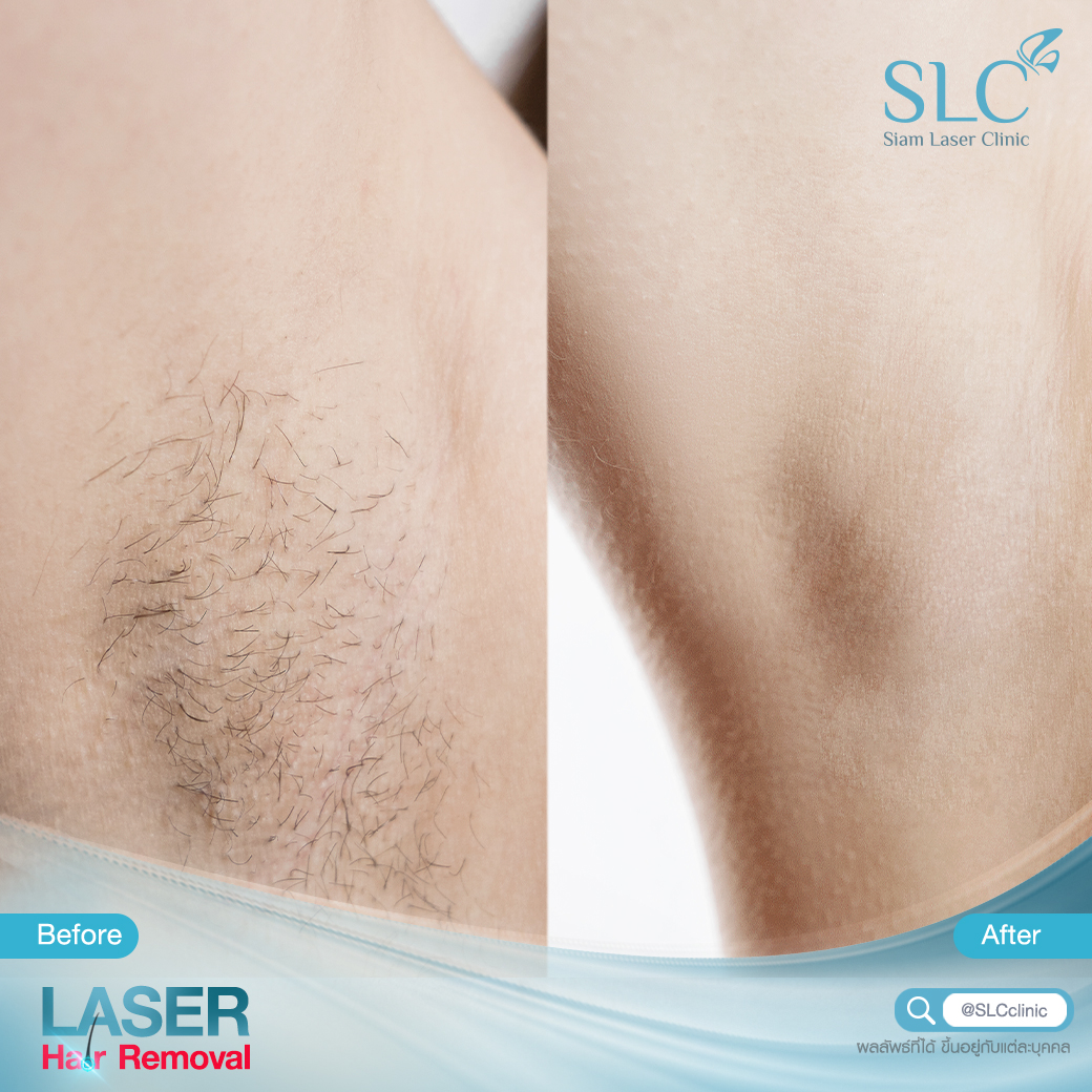 เลเซอร์กำจัดขน_Laser Hair Removal