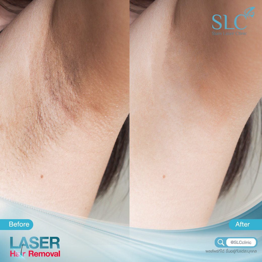 เลเซอร์กำจัดขน_Laser Hair Removal