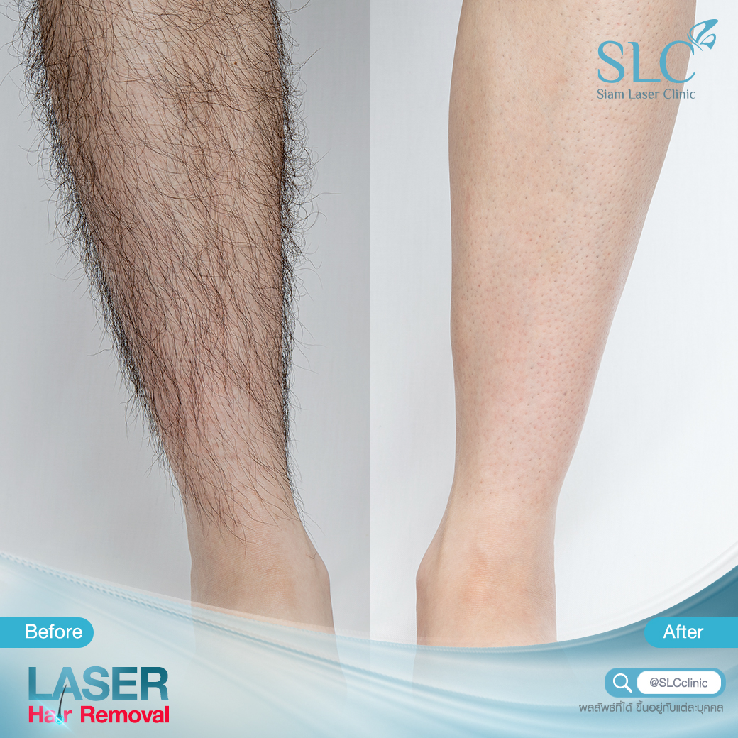 เลเซอร์กำจัดขน_Laser Hair Removal