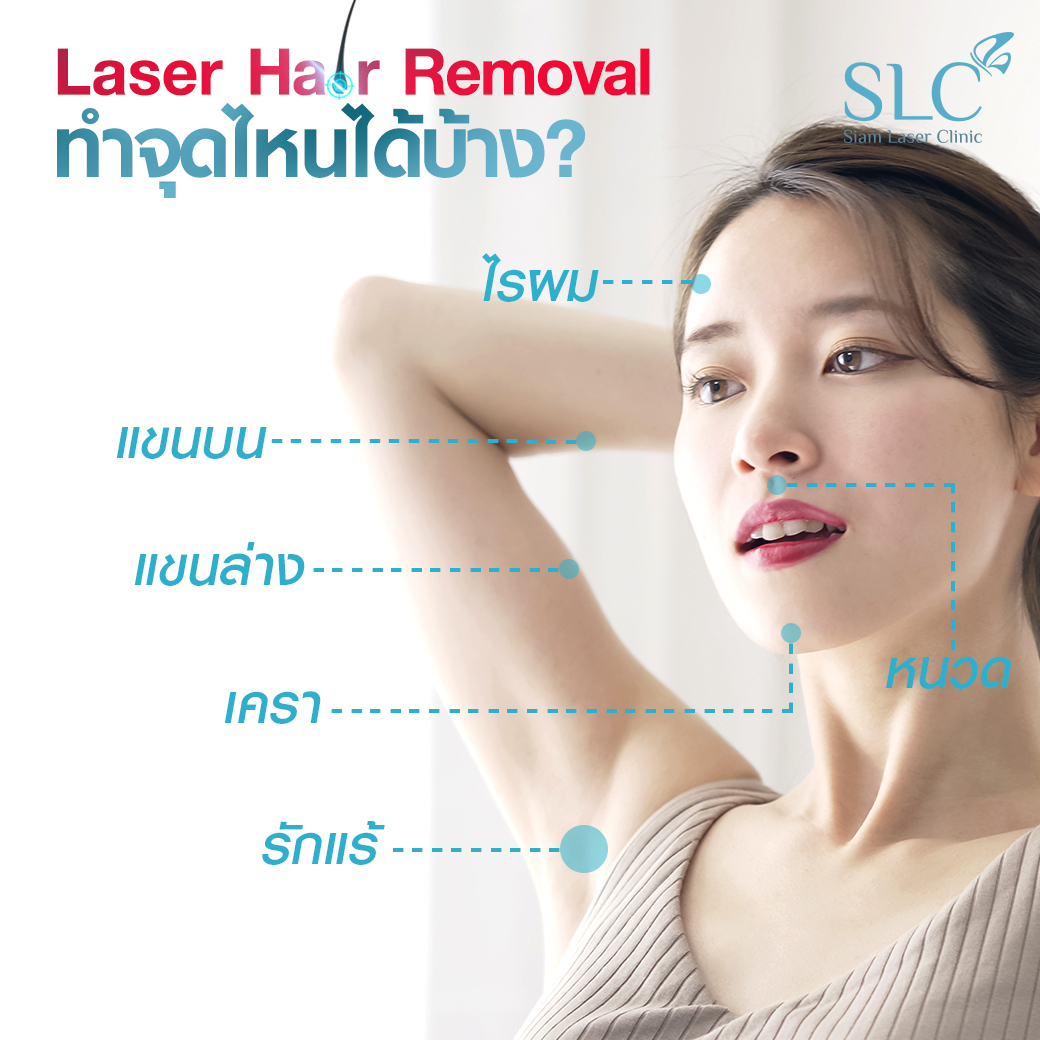 เลเซอร์กำจัดขน_Laser Hair Removal