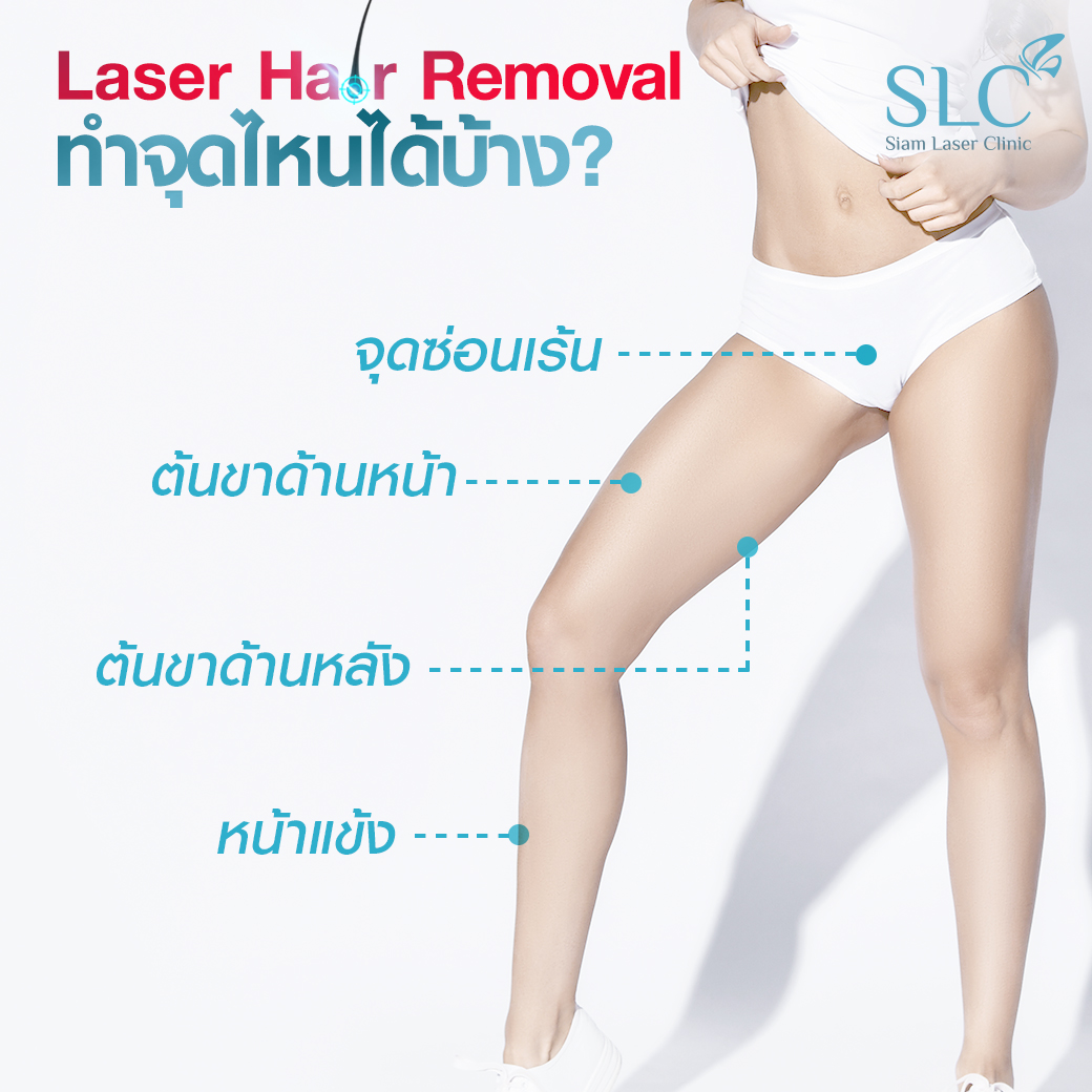 เลเซอร์กำจัดขน_Laser Hair Removal