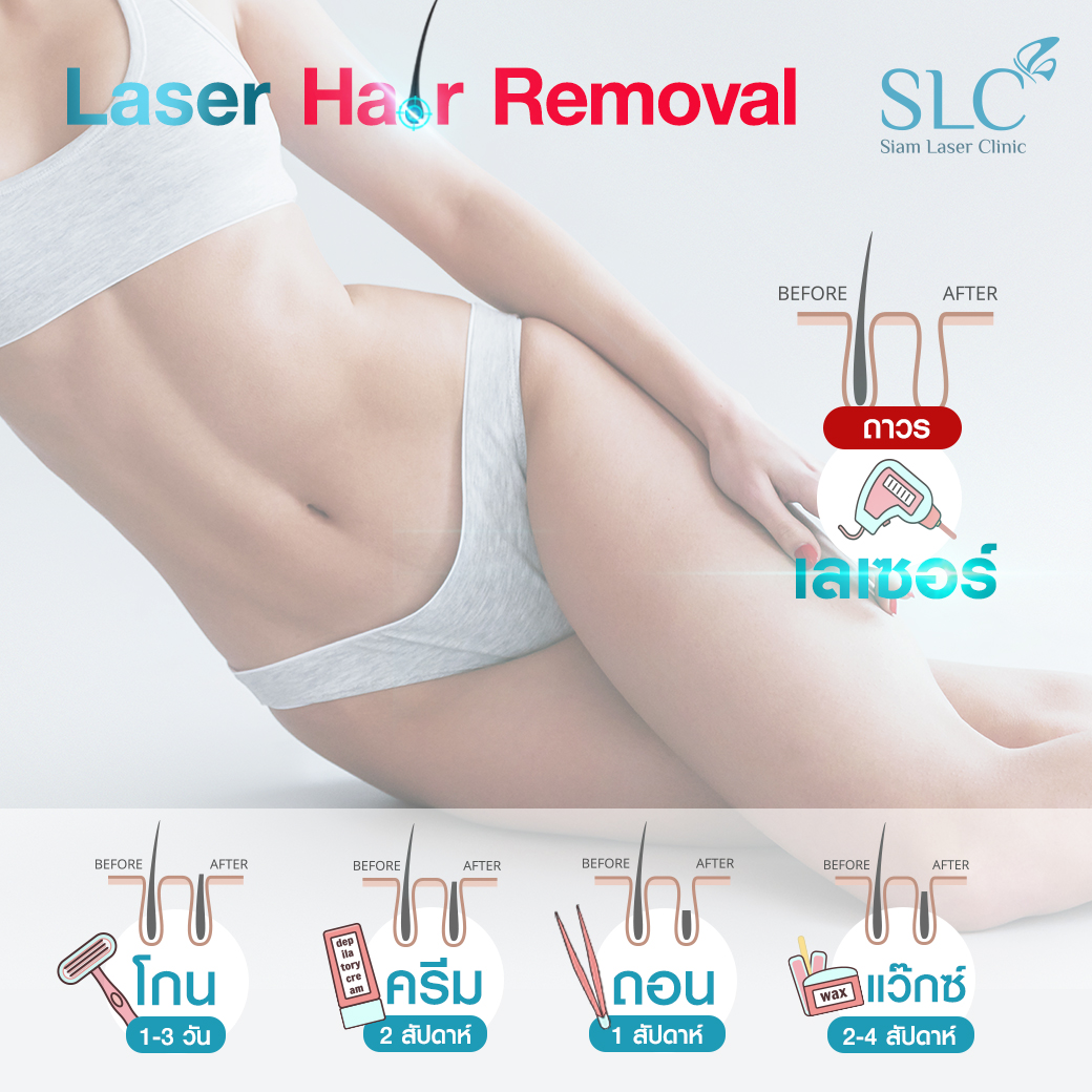 เลเซอร์กำจัดขน_Laser Hair Removal