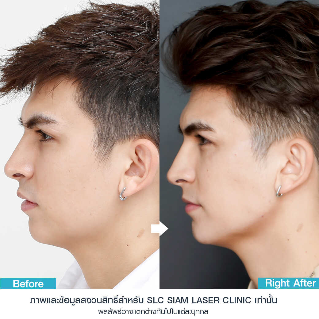 Filler_Jawline_ปรับรูปหน้า_ฟิลเลอร์