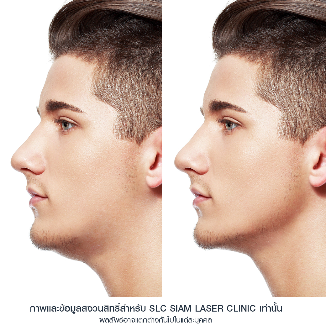 Filler_Jawline_ปรับรูปหน้า_ฟิลเลอร์