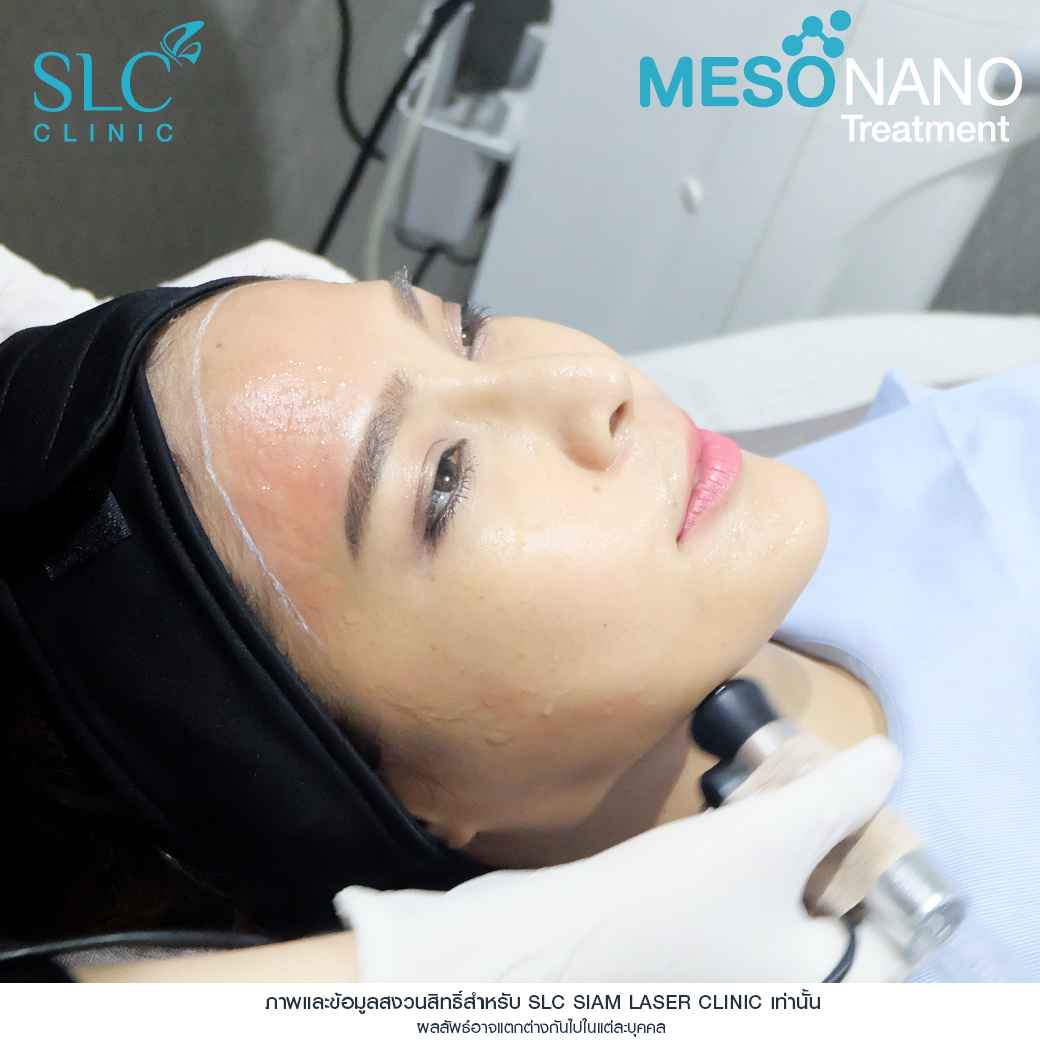 Meso Nano Treatment_เมโสหน้าใส_ทรีทเมนท์หน้าใส