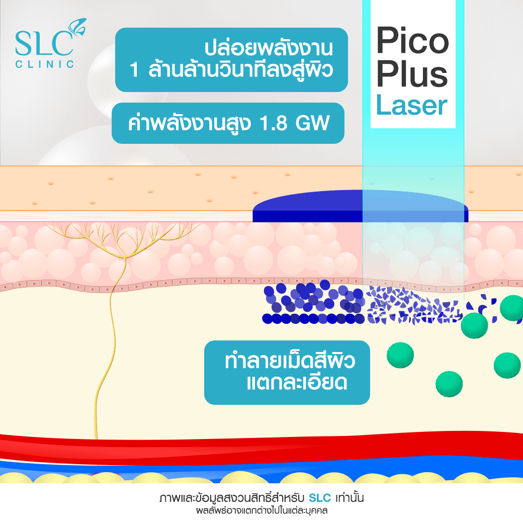 PicoLaser รักษาหลุมสิว_เลเซอร์กระ_เลเซอร์ฝ้า_ลบรอยสัก 