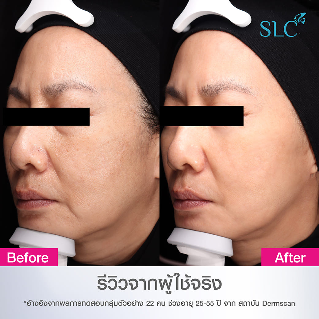 SLC 7 Peptides-Hya Intensive Serum ซีรั่มลดริ้วรอย เซรั่มหน้าเด็ก ยกกระชับผิว ลดฝ้า กระ 