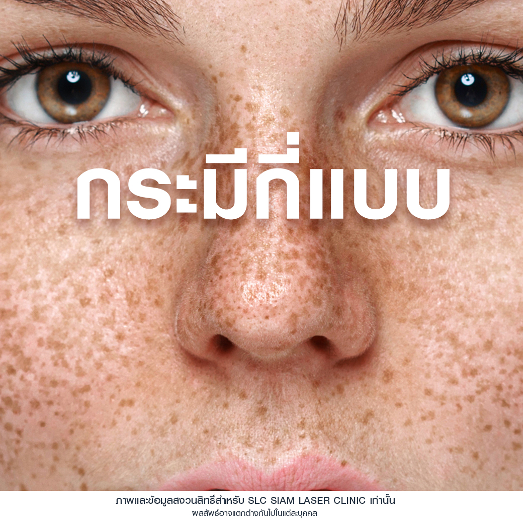 Rejuvenate Laser Brightening_เลเซอร์หน้าใส ลดฝ้า กระ จุดด่างดำ 