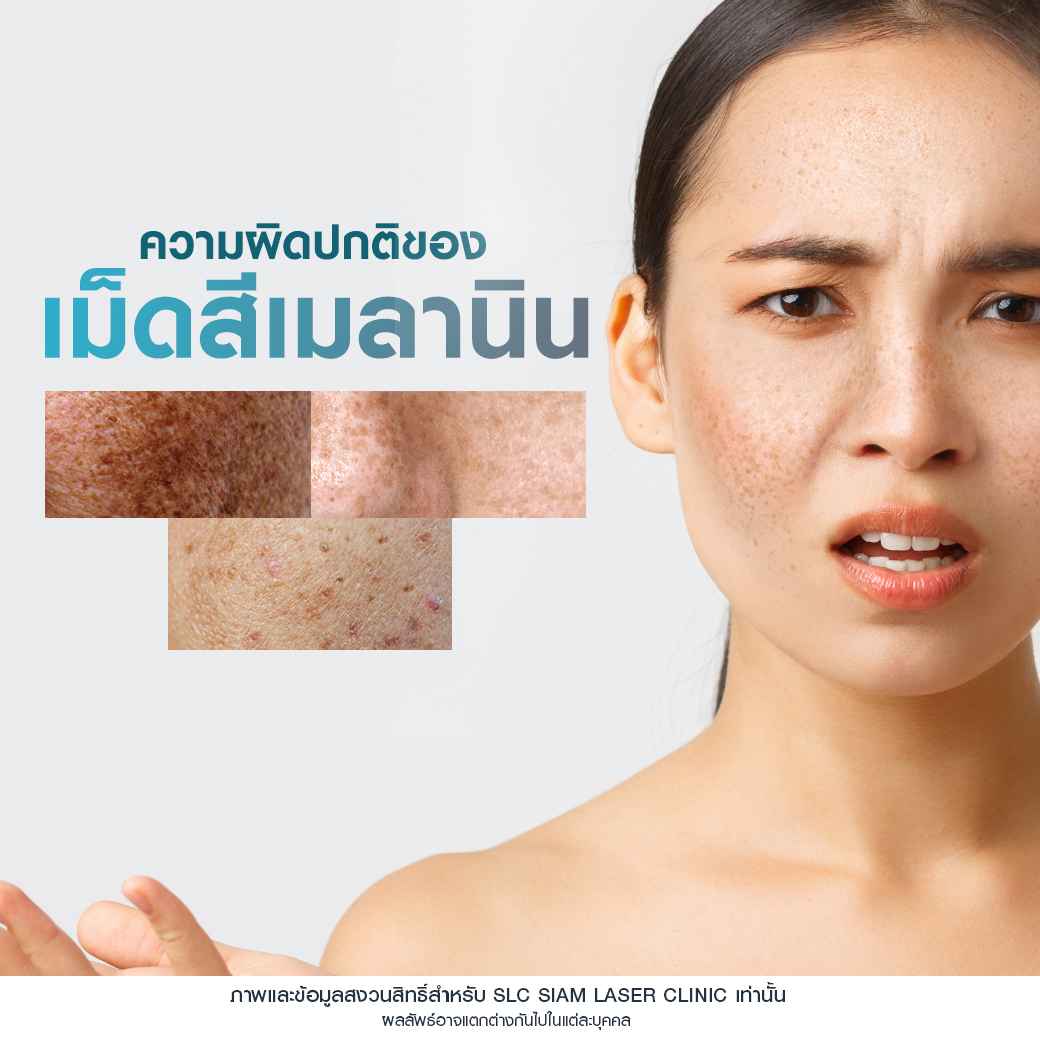 Rejuvenate Laser Brightening_เลเซอร์หน้าใส ลดฝ้า กระ จุดด่างดำ 