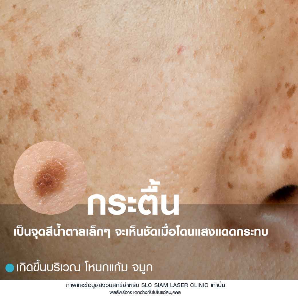 Rejuvenate Laser Brightening_เลเซอร์หน้าใส ลดฝ้า กระ จุดด่างดำ 