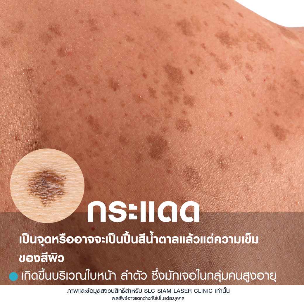 Rejuvenate Laser Brightening_เลเซอร์หน้าใส ลดฝ้า กระ จุดด่างดำ 