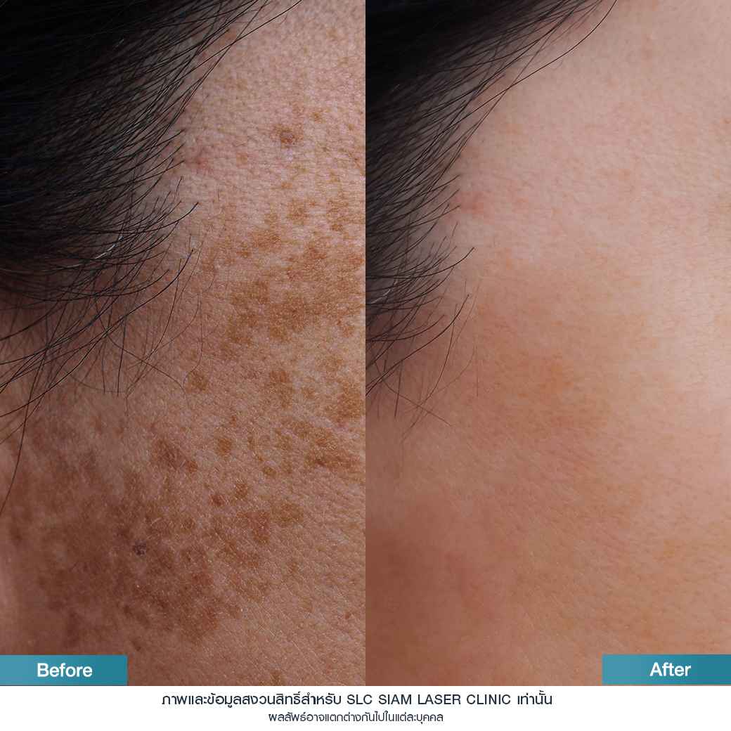 Rejuvenate Laser Brightening_เลเซอร์หน้าใส ลดฝ้า กระ จุดด่างดำ 