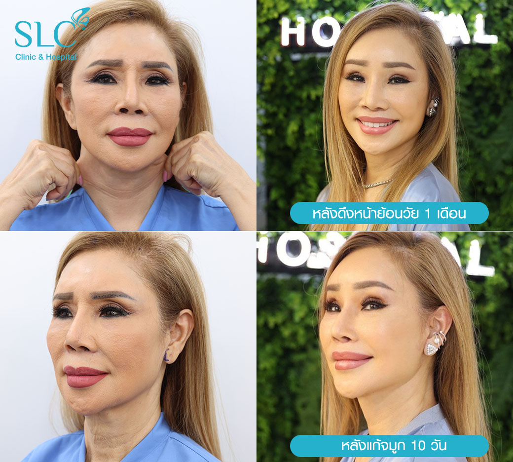 หน้าใหม่มูนา ซารูณีย์ Face Lift มูนาศัลยกรรม มูนาดึงหน้า