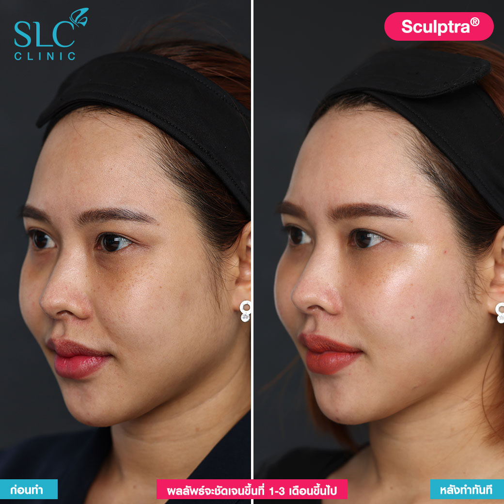 sculptra คือ ไหมน้ำ เมโสคอลลาเจน ฉีดหน้า หน้าเหี่ยวเหมือนคนแก่ทำไง