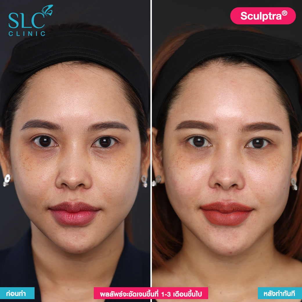 เติมร่องแก้ม กระชับหน้า Sculptra คืออะไร ฉีดผิว แก้หน้าเหี่ยว ฉีดฟิลเลอร์ยกหน้า ไหมน้ำ