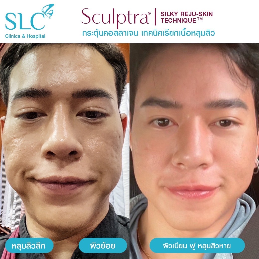 Sculptra ราคา , ฉีดกระตุ้นคอลลาเจนรักษาหลุมสิว , หลุมสิว