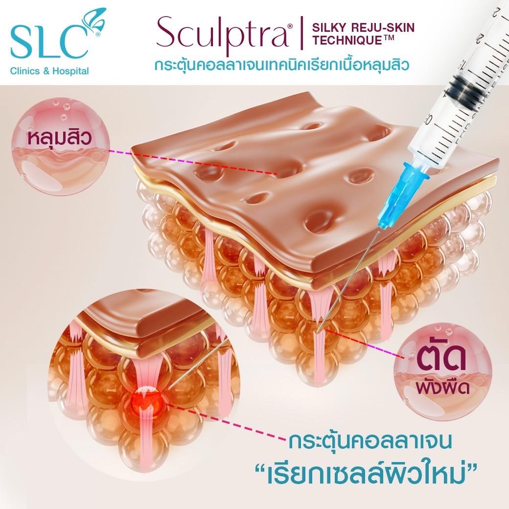 รักษาหลุมสิวที่ไหนดี , Subcision หลุมสิว