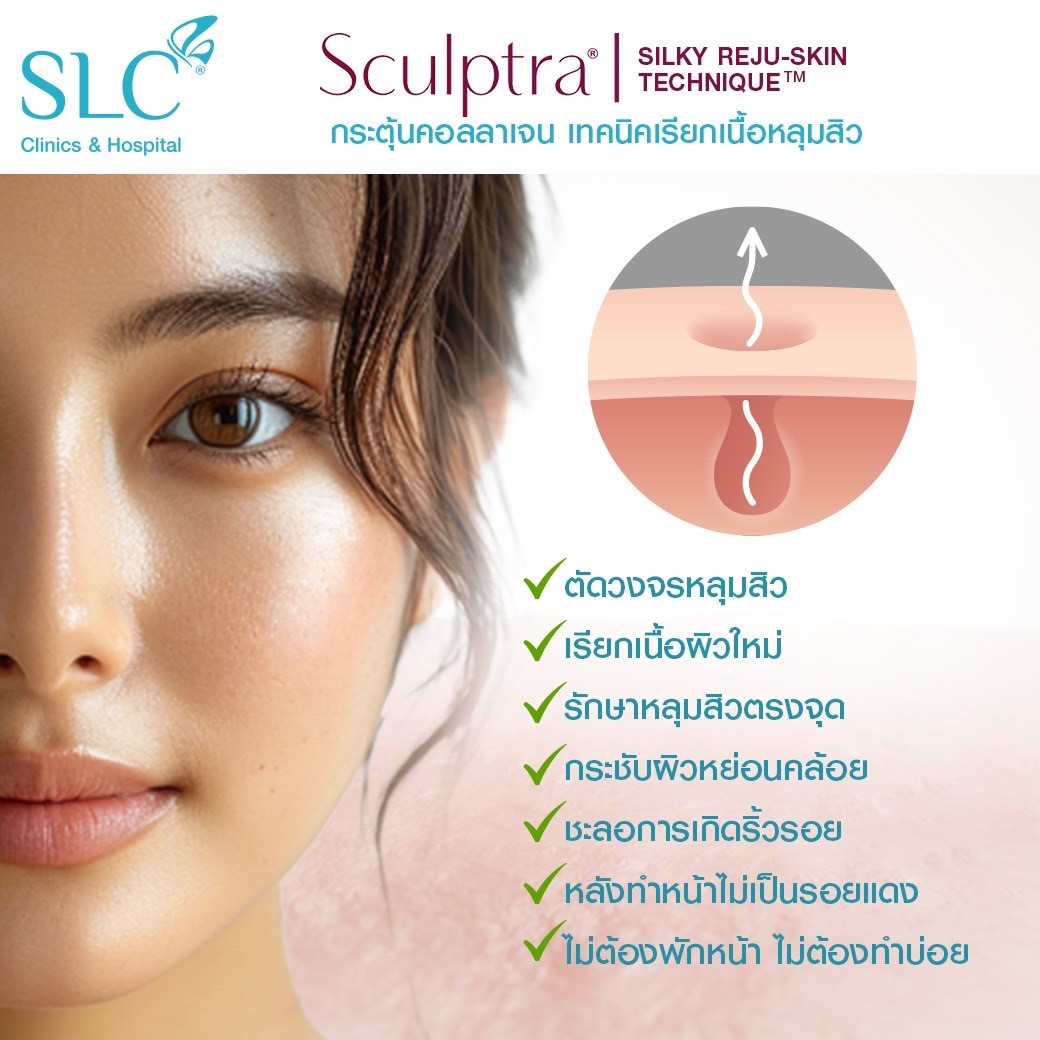 รีวิว Sculptra , เทคนิคเรียกเนื้อหลุมสิว , Silky Reju-Skin Technique™