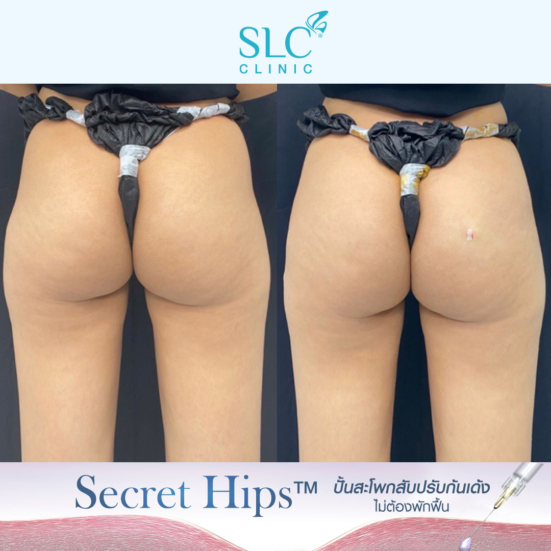 รีวิวเติมสะโพก , รีวิวเติมก้น , รีวิวเติมก้นบุ๋ม , รีวิวฉีดก้น , Variofill , Secret Hips