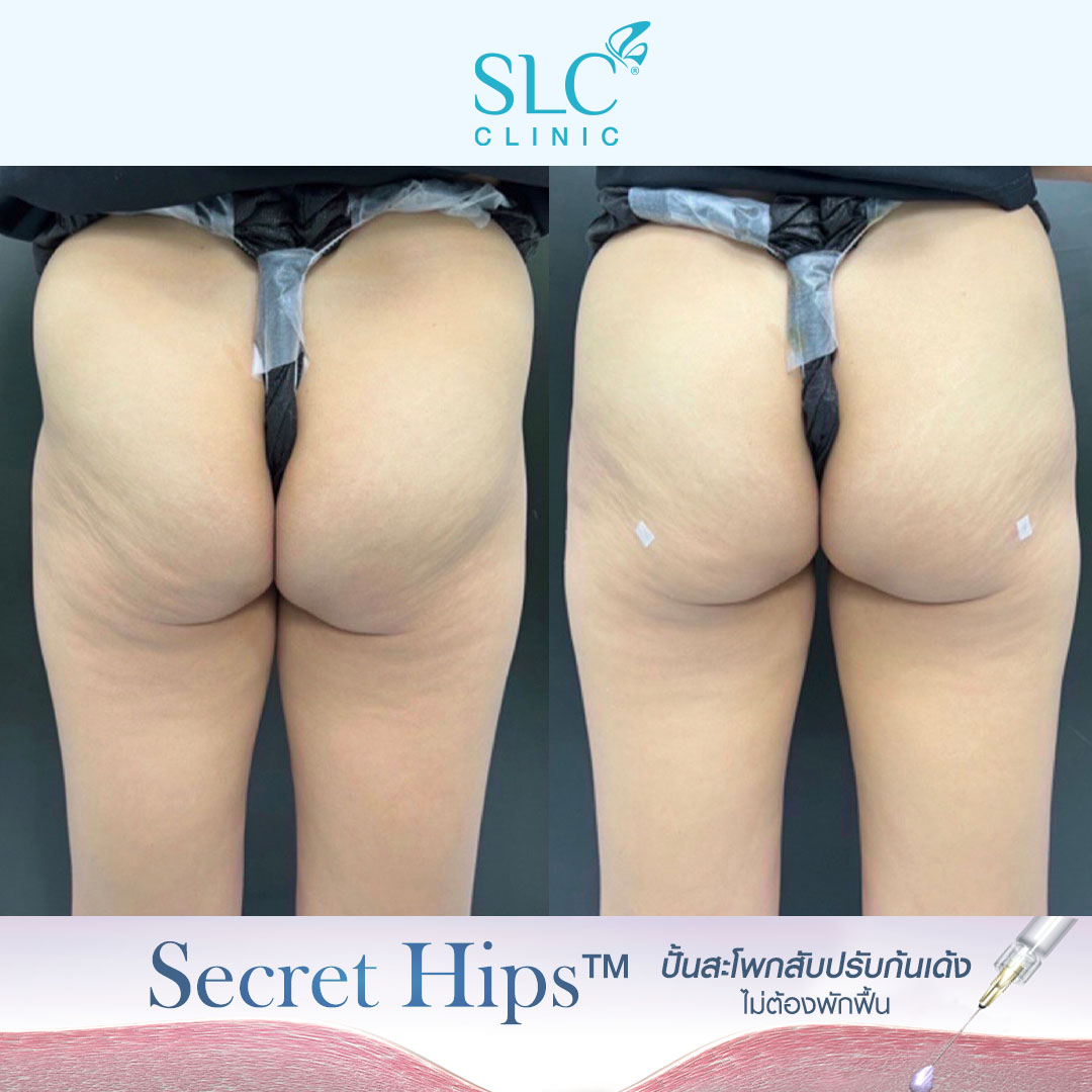 รีวิวเติมสะโพก , รีวิวเติมก้น , รีวิวเติมก้นบุ๋ม , รีวิวฉีดก้น , Variofill , Secret Hips