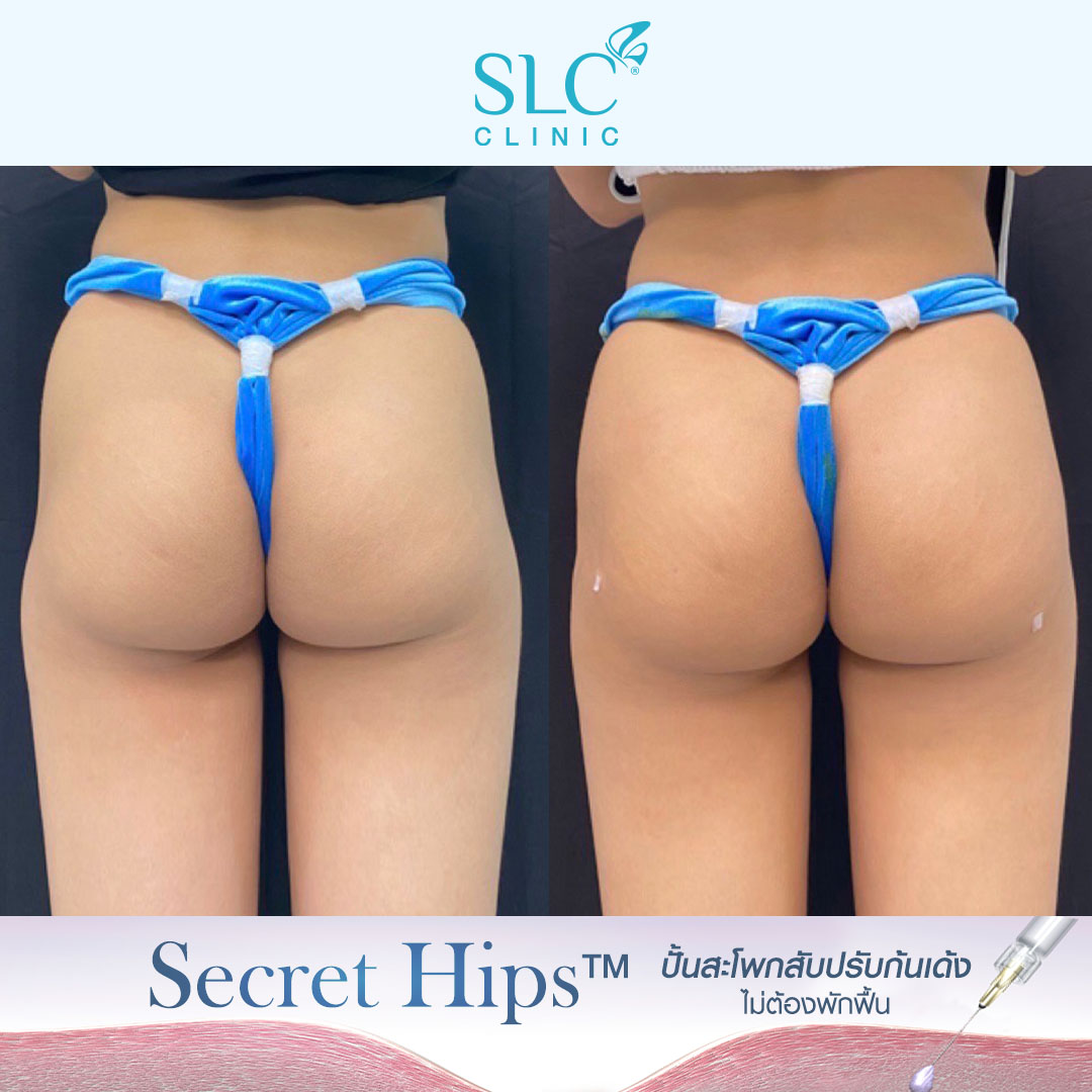 รีวิวเติมสะโพก , รีวิวเติมก้น , รีวิวเติมก้นบุ๋ม , รีวิวฉีดก้น , Variofill , Secret Hips