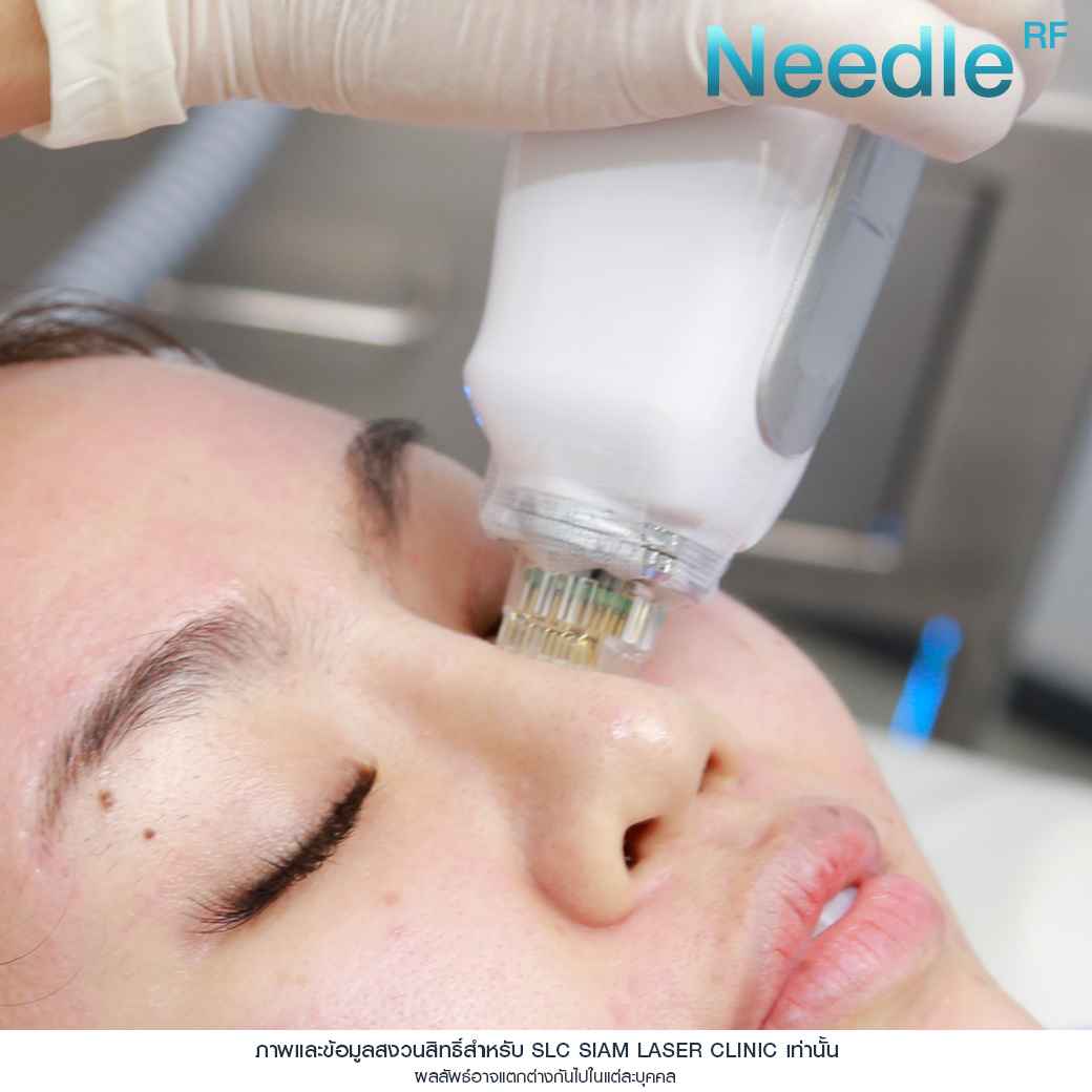 Needle RF_รักษาหลุมสิว_รักษาสิว_ลดริ้วรอย