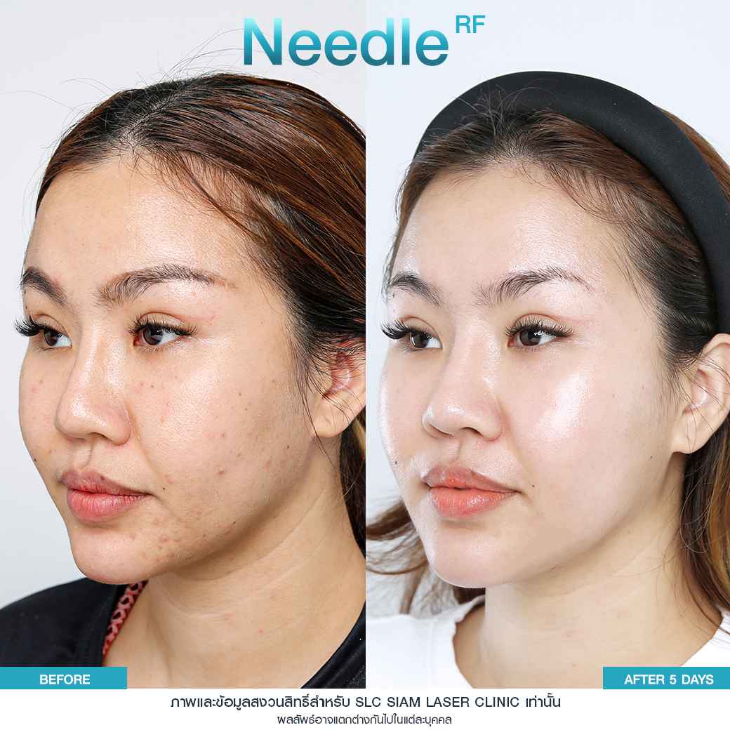 Needle RF_รักษาหลุมสิว_รักษาสิว_ลดริ้วรอย