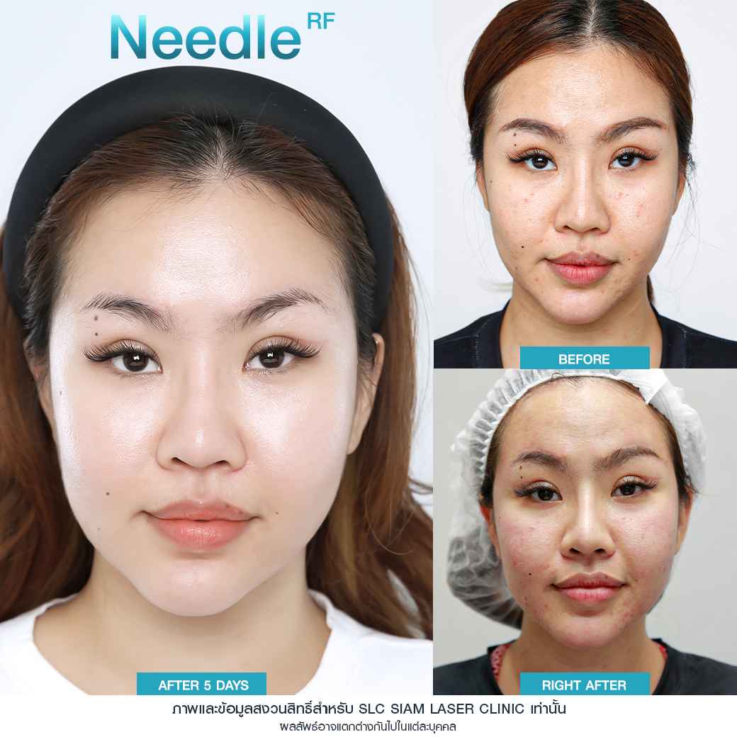 Needle RF_รักษาหลุมสิว_รักษาสิว_ลดริ้วรอย