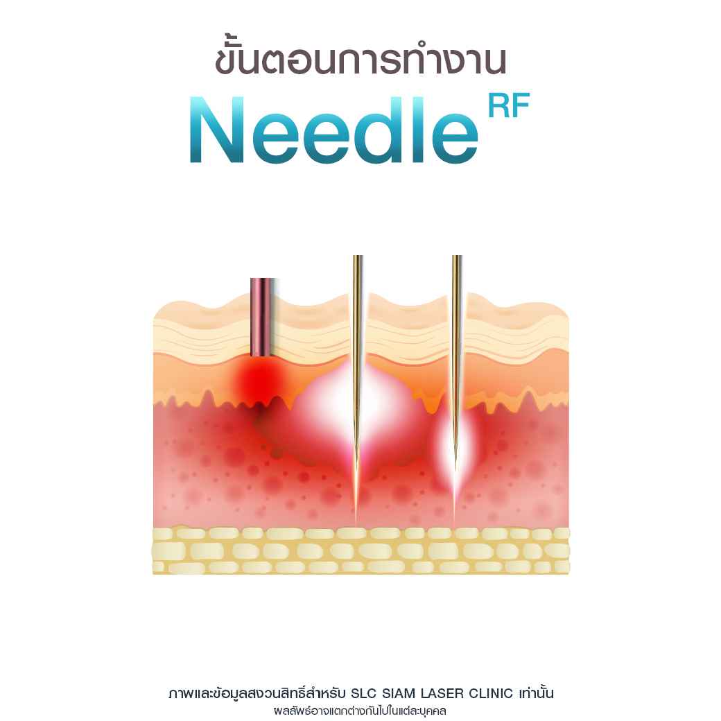 Needle RF_รักษาหลุมสิว_รักษาสิว_ลดริ้วรอย