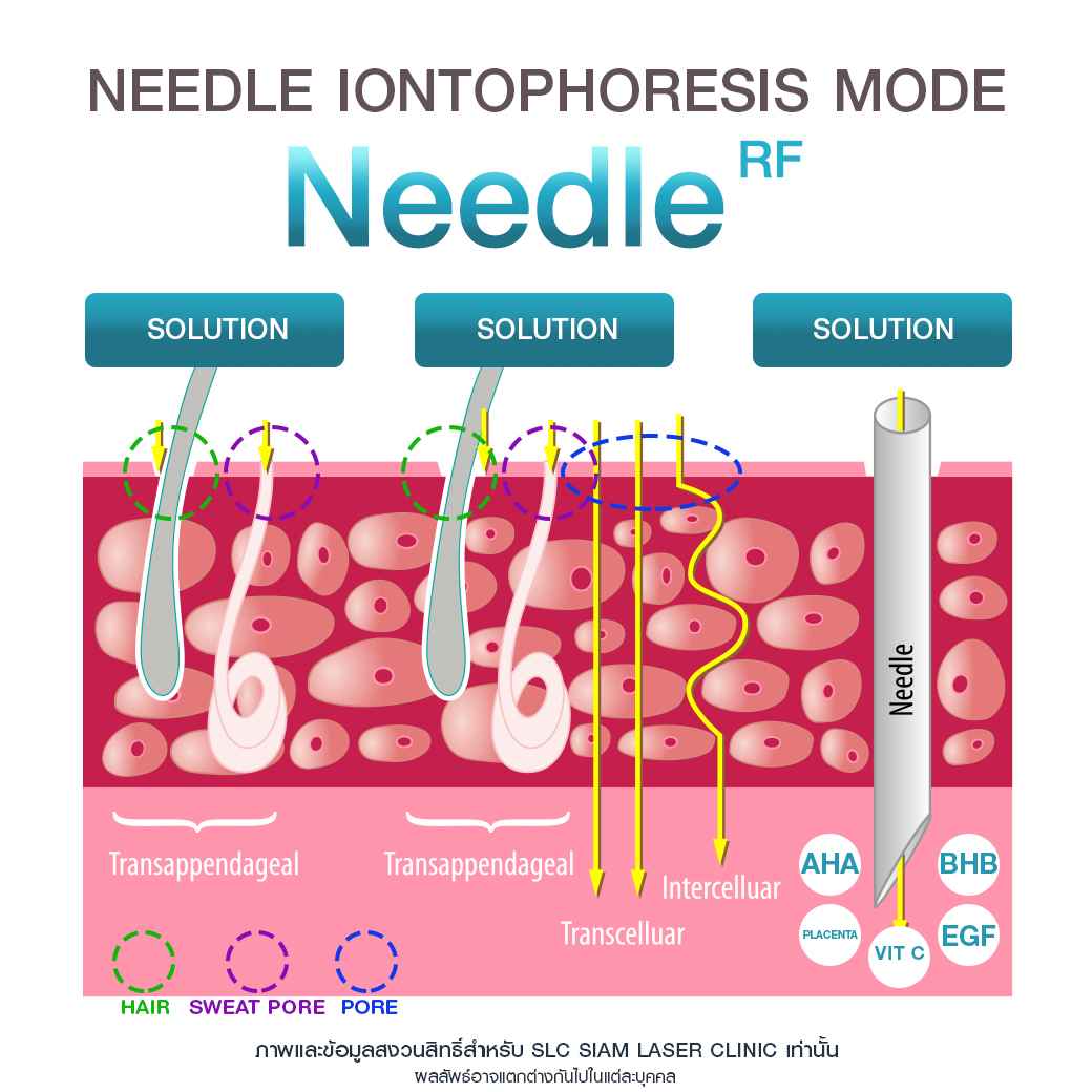 Needle RF_รักษาหลุมสิว_รักษาสิว_ลดริ้วรอย