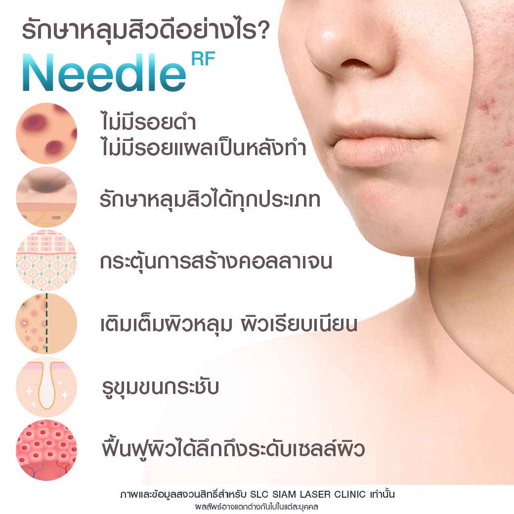 Needle RF_รักษาหลุมสิว_รักษาสิว_ลดริ้วรอย