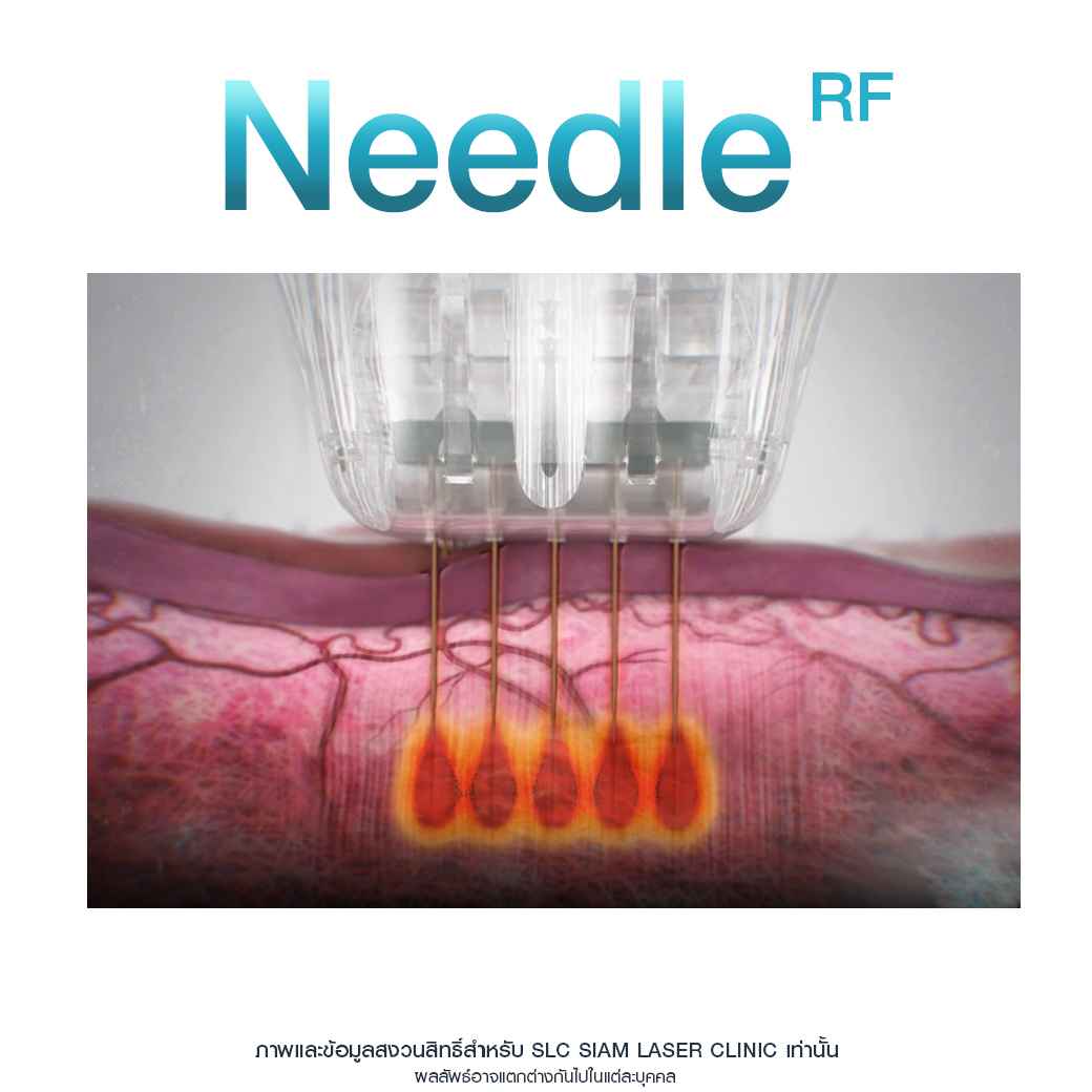 Needle RF_รักษาหลุมสิว_รักษาสิว_ลดริ้วรอย