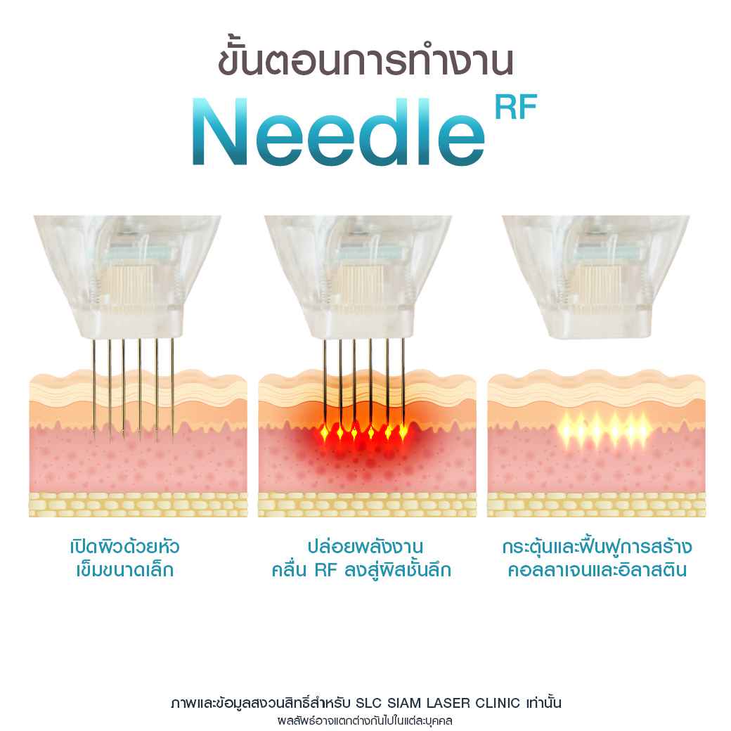 Needle RF_รักษาหลุมสิว_รักษาสิว_ลดริ้วรอย