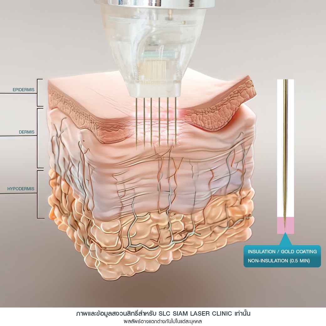 Needle RF_รักษาหลุมสิว_รักษาสิว_ลดริ้วรอย